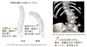 腰椎 後弯 側弯