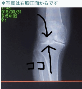 変形性膝関節症 施術