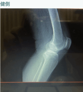 変形性膝関節症 施術