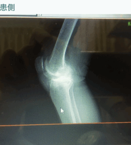 変形性膝関節症 施術